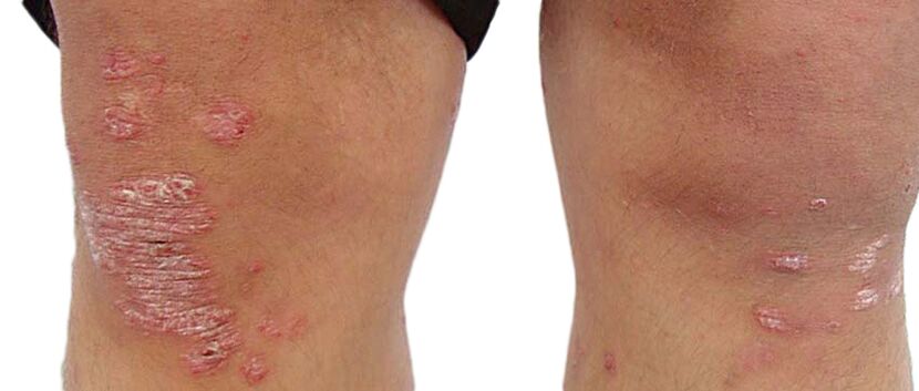 Psoriasis is an unpleasant skin condition that requires treatment with Keraderm cream. 