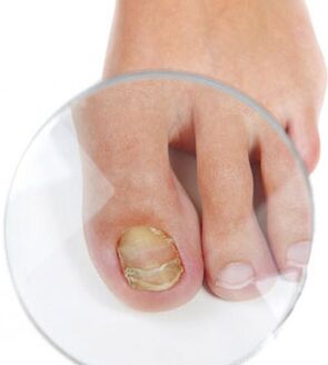 Nail fungus