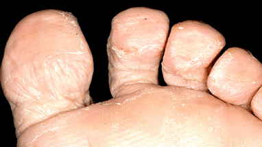 How to recognize the presence of a fungus between the fingers of the feet