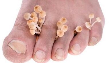 The reasons for the development of the fungus between the fingers of the feet