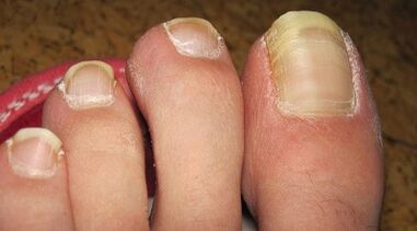 How the fungus manifests in the nails