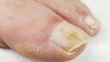 The initial stage of nail fungus development