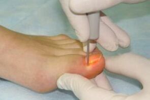 mechanical nail removal for fungal infection
