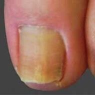 Yeast lesions of the nail.