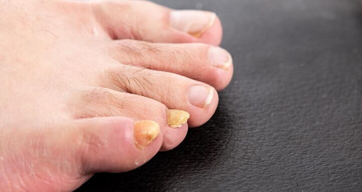 Yellowing of the nails due to foot fungus.