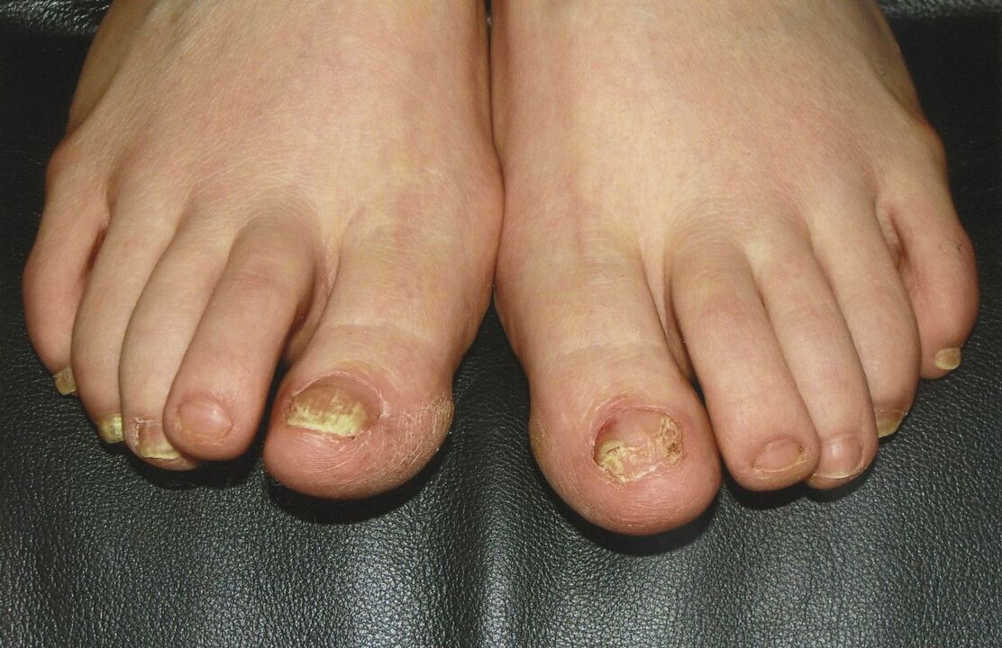 How to treat toenail fungus with nail polish.