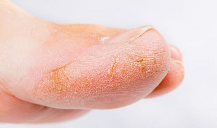 Symptoms of fungus on the skin of the feet.