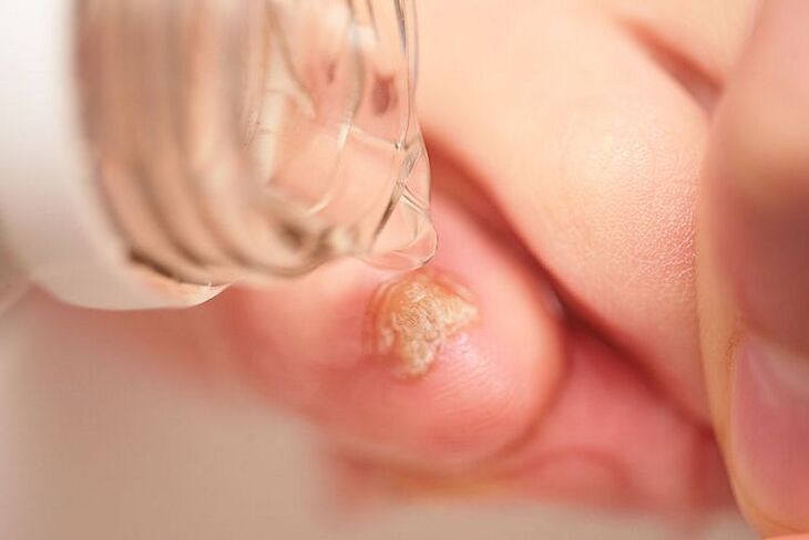 How does hydrogen peroxide act on fungi