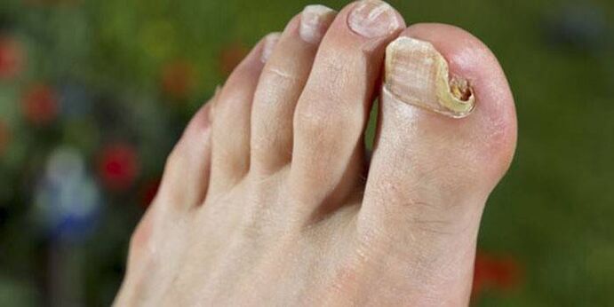 Fungus on the nail of the big toe.