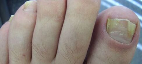 symptoms of nail fungus and its treatment with vinegar