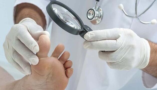 Fungal diagnosis.