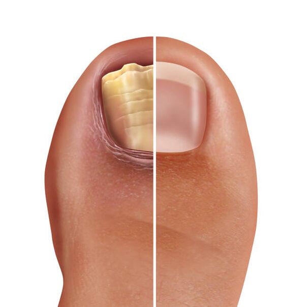 healthy and fungal nails