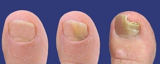 Development of fungus on the toenails. 