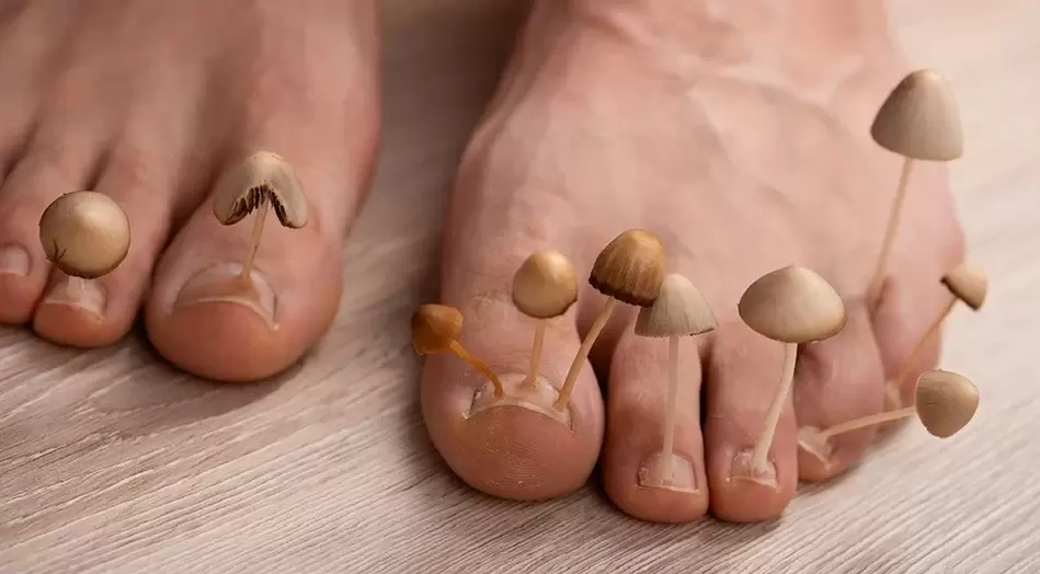 Fungal infection that affects the toenails. 