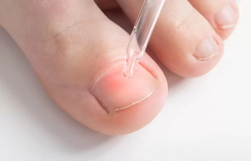 Treatment of onychomycosis with an antifungal solution. 