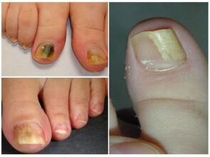Appearance of toenails with onychomycosis. 