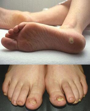 Manifestations of mycosis on the skin and toenails. 