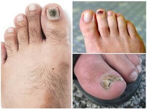 Signs of a toenail fungal infection