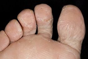 The skin of the feet with a fungal infection. 