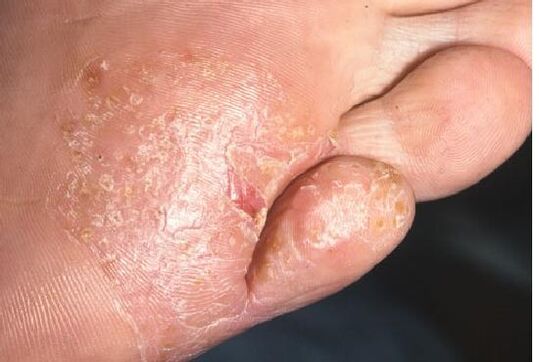 Manifestations of a fungal infection on the skin of the foot. 
