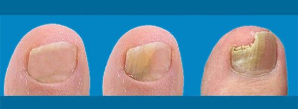 The development of onychomycosis toenail fungus. 
