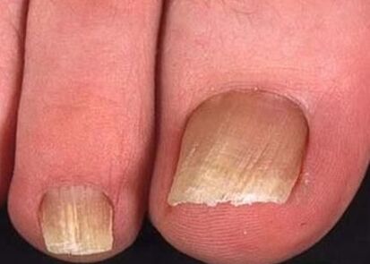 Nail fungus on the legs of the initial stage