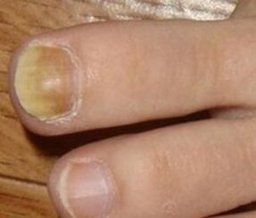 Symptoms of the initial stage of nail fungus
